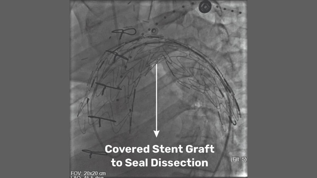 Medical Marvel at SSB Heart and Multispeciality Hospital: Pioneering Hybrid Procedure Saves a Life - PNN Digital